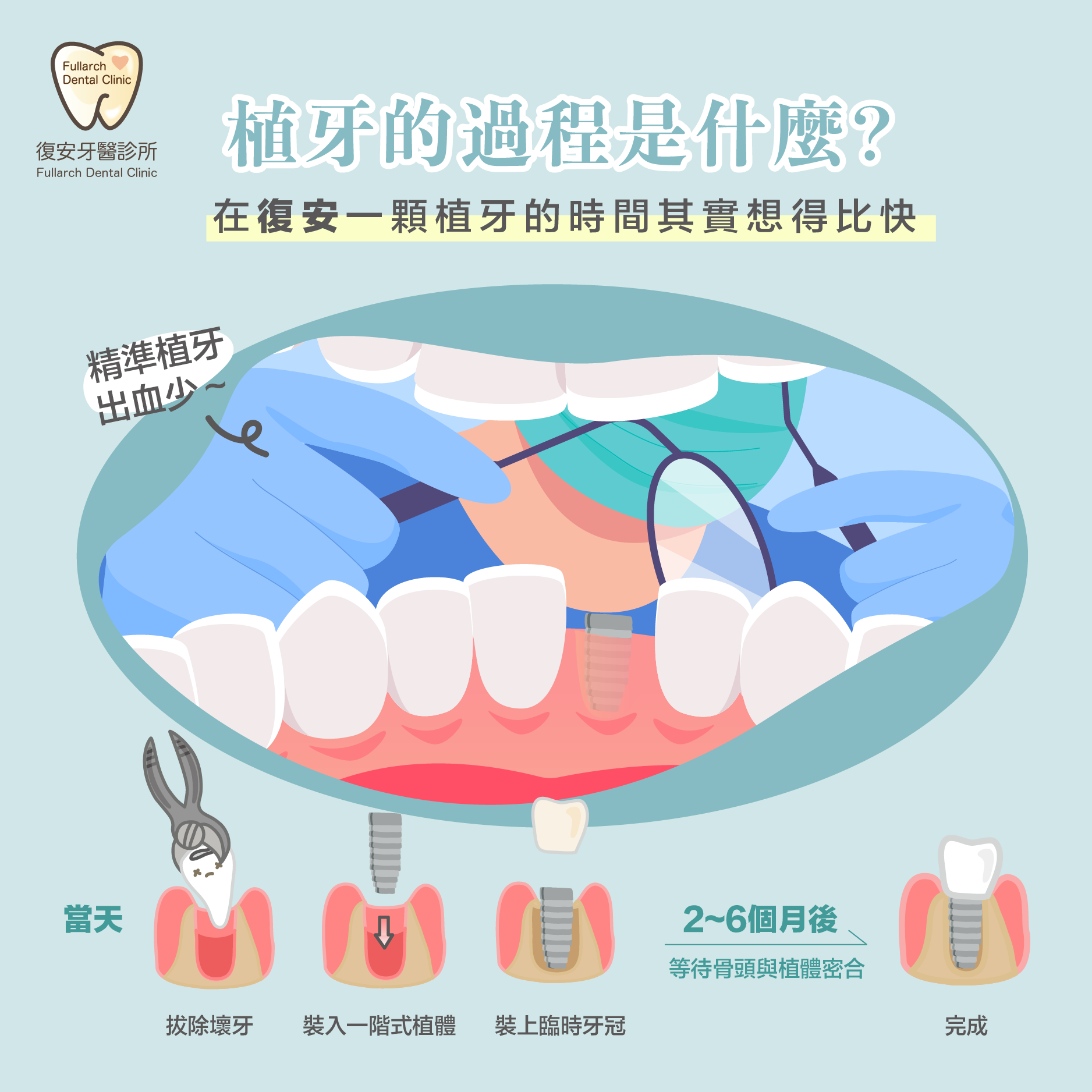 復安牙醫診所 -- 植牙的過程是什麼？